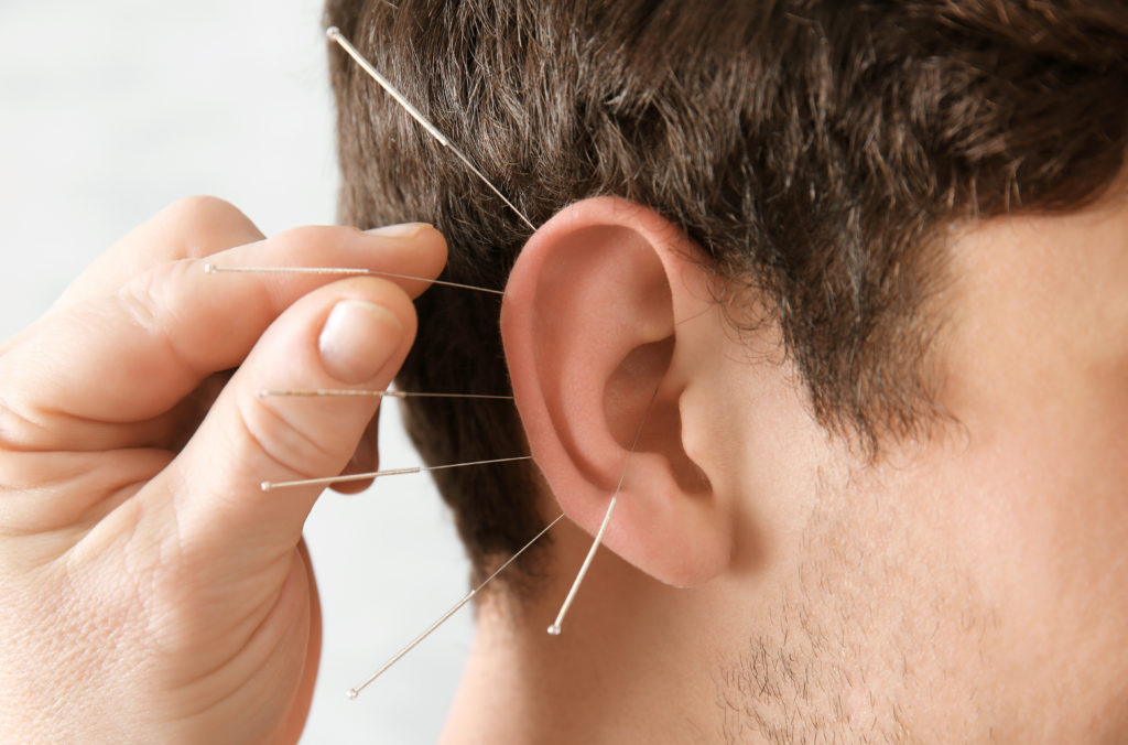 acupuntura de la oreja